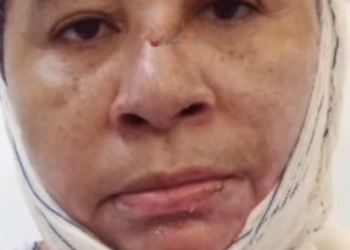 Dona de casa sofre graves queimaduras em acidente com gasolina em José de Freitas